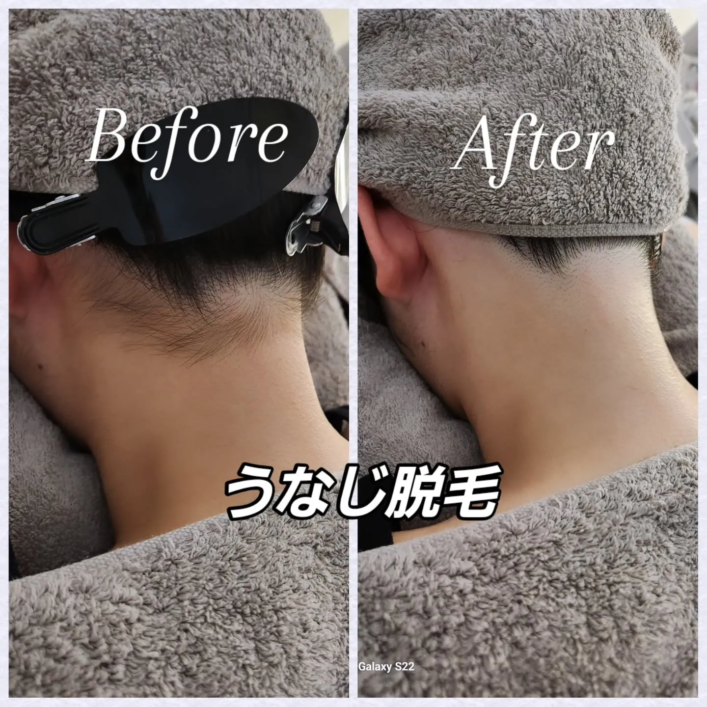 女性脱毛